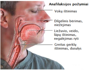 anafilaksijos požymiai