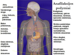 anafilaksijos požymiai